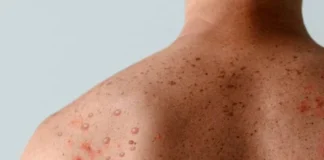 Sesab confirma dois casos de Mpox na Bahia e esclarece fake news