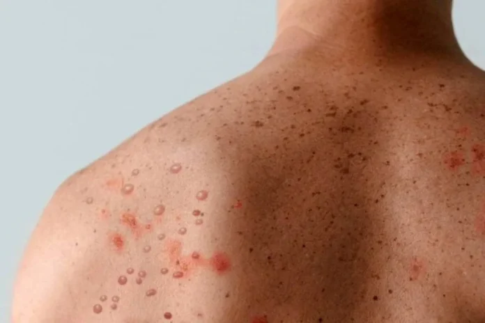 Mpox-Foto-Reproducao-1152x768-1