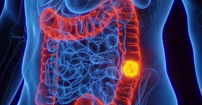 cancer-colorretal-sus-oferta-novo-teste-para-rastr0139823700202608111152-ScaleDownProportional